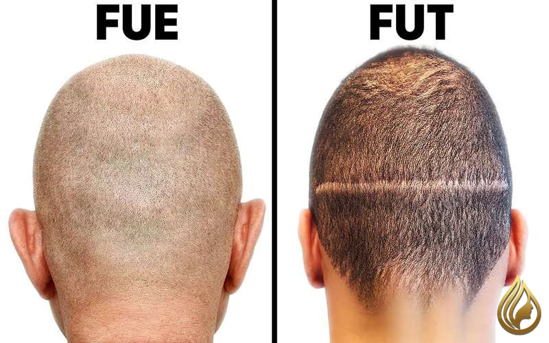  تفاوت FUT و FUE چیست؟