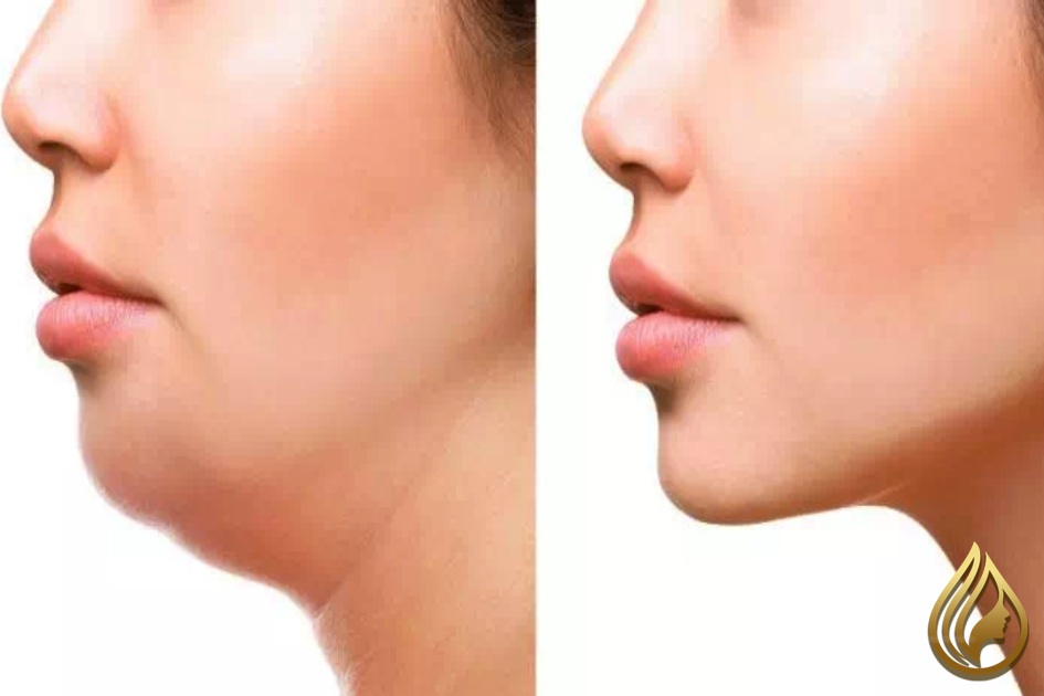لیپوماتیک یا لیپوساکشن غبغب؟ کدام برای شما مناسب است؟