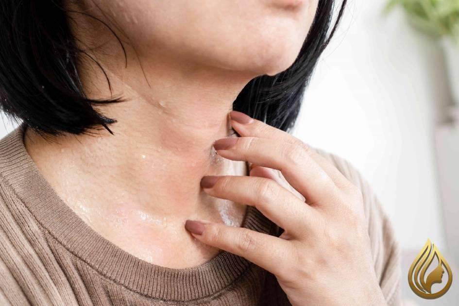 خارش پوست بعد از لیپوماتیک غبغب چه دلایلی دارد؟راه درمان چیست؟